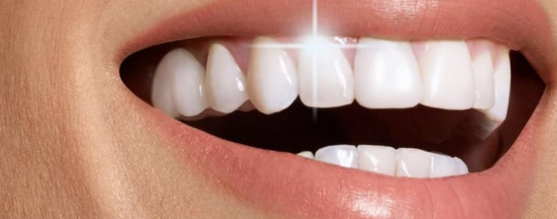 Косметическое отбеливание зубов - о процедуре