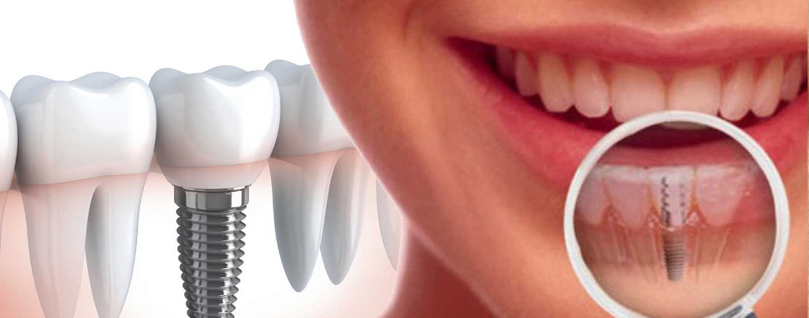 Имплантация зубов - 
о процедуре